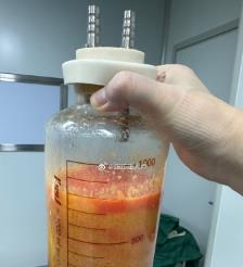 贺州水动力吸脂手术要做多久？